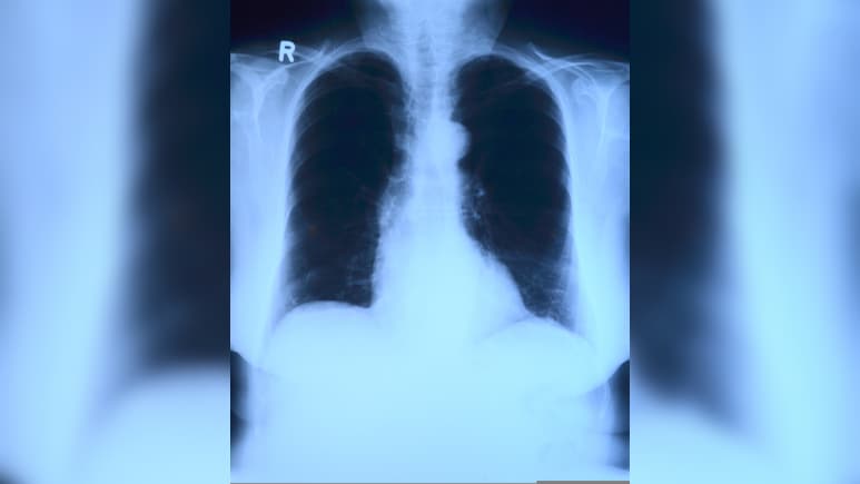 AI May Be Guessing X-Ray Results, Not Reading Them: Study
