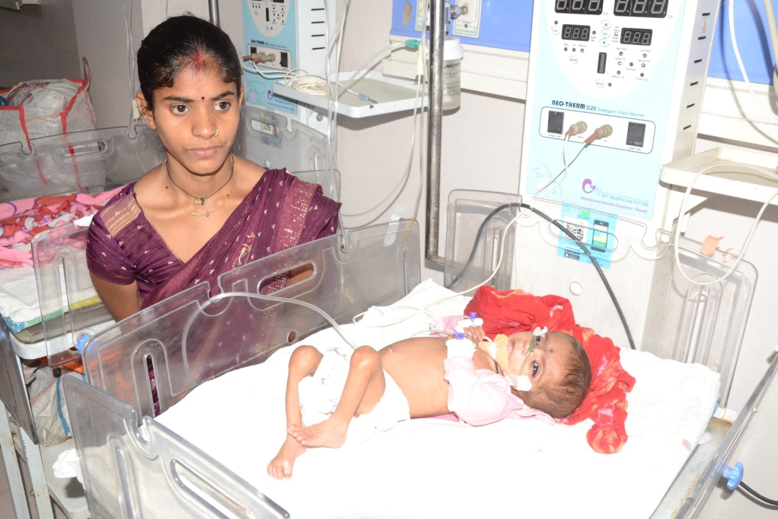 After Surangi, Another Severe Case of Malnutrition in Satna Nayagaon