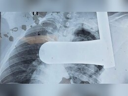 उदयपुर: सीने के आर-पार घुसा 9 इंच का लोहे का पाइप डॉक्टरों ने निकाला, फेफड़े और गर्दन को चीरकर था फंसा