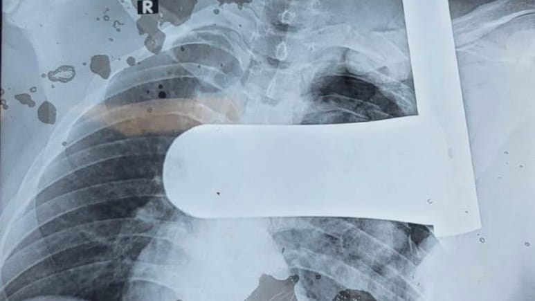 उदयपुर: सीने के आर-पार घुसा 9 इंच का लोहे का पाइप डॉक्टरों ने निकाला, फेफड़े और गर्दन को चीरकर था फंसा