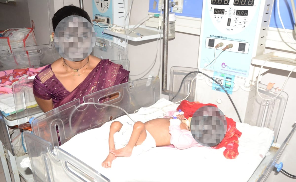 MP में पोषण अभियान पर उठे सवाल; सतना के नयागांव में कुपोषण का नया कलंक, गंभीर कुपोषित बच्ची का एक कान ही नहीं