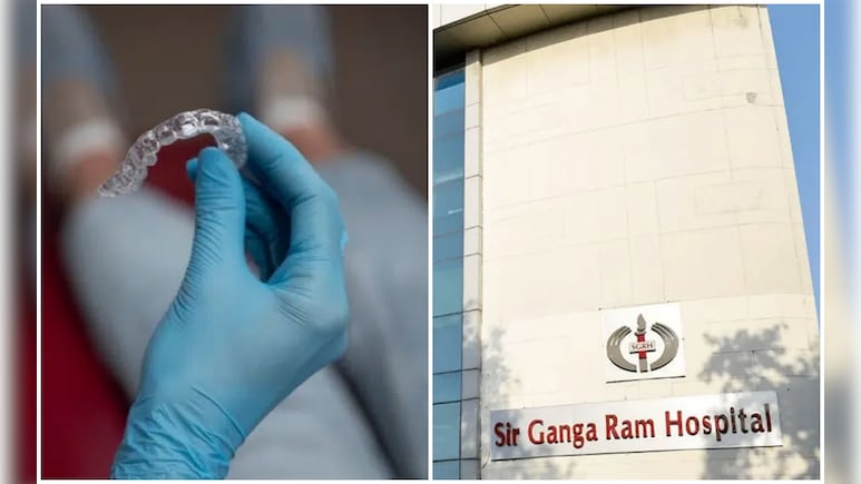 फूड पाइप में फंसी थी नकली दांतों की प्लेट, डॉक्टरों ने बिना ओपन सर्जरी के बचाई मरीज की जान