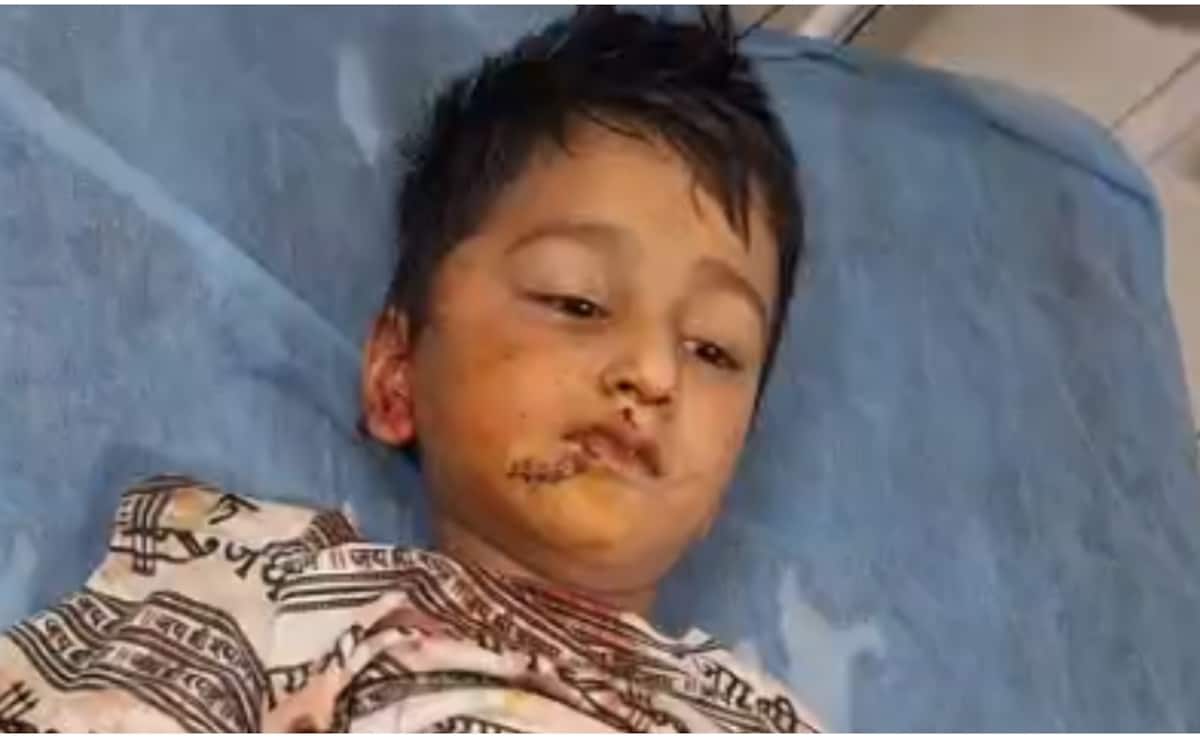 राजस्थान: घर के बाहर खेल रहे 5 साल के बच्चे पर आवारा कुत्ते ने किया हमला, चेहरे और कान पर आए 20 टांके