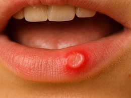 मुंह के छालों से हैं परेशान? दादी नानी के ये घरेलु नुस्खे दिला सकते हैं राहत