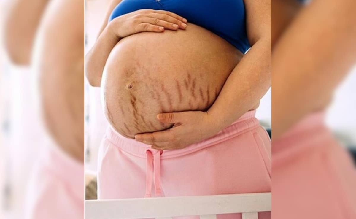 प्रेग्नेंसी स्ट्रेच मार्क्स से हैं परेशान? तो अपनाएं ये घरेलू उपाय
