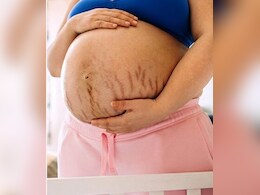 प्रेग्नेंसी स्ट्रेच मार्क्स से हैं परेशान? तो अपनाएं ये घरेलू उपाय