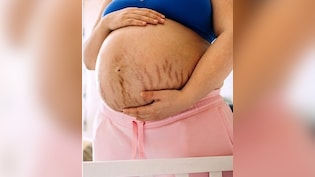 प्रेग्नेंसी स्ट्रेच मार्क्स से हैं परेशान? तो अपनाएं ये घरेलू उपाय