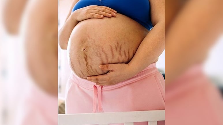 प्रेग्नेंसी स्ट्रेच मार्क्स से हैं परेशान? तो अपनाएं ये घरेलू उपाय