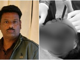 बूंदी में 11KV तार से झुलसे बाइक सवार की 3 घंटे चली सर्जरी, आए 100 टांके; गर्दन चीरकर बनानी पड़ी सांस की नली