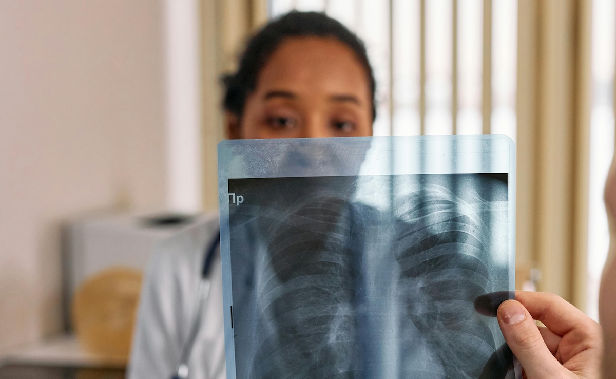 New TB Test Using AI: अब एआई करेगा टीबी दवा-प्रतिरोध की सटीक पहचान, जांच का बदल जाएगा तरीका