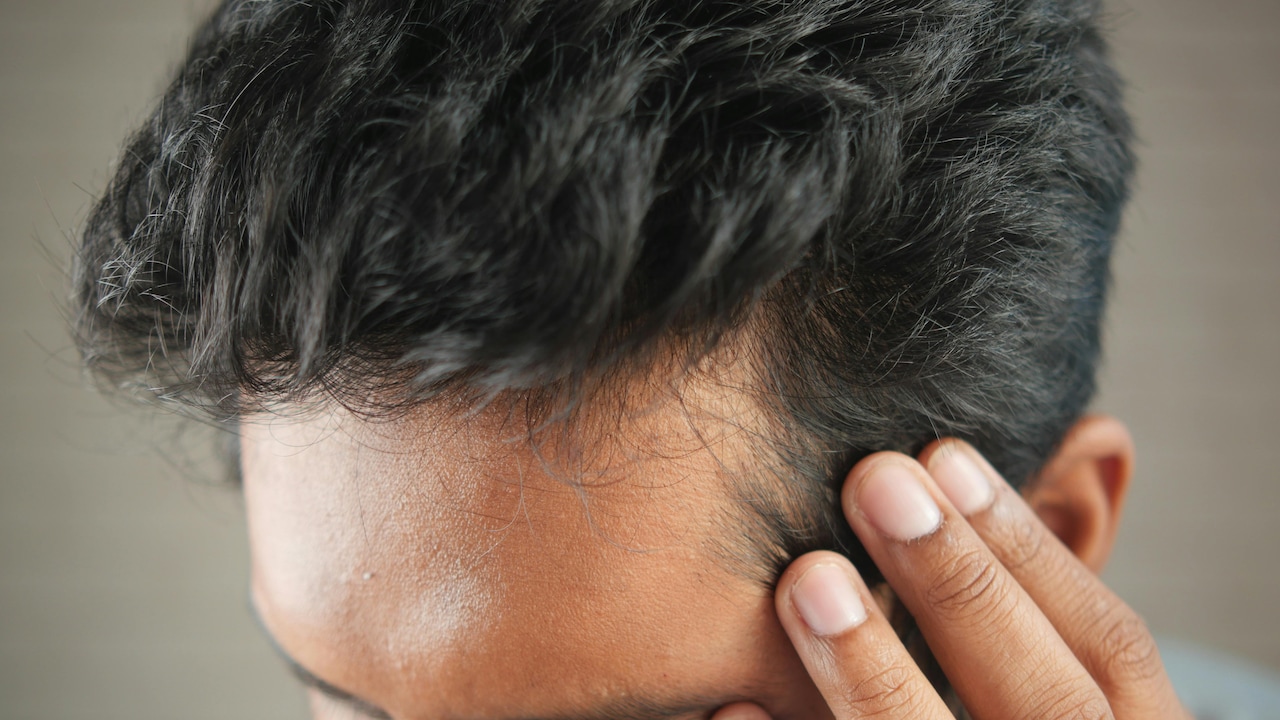 Microneedling helps activate dormant hair follicles by improving blood circulation to the scalp.