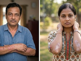 Eczema vs Psoriasis: Which Skin Condition Is Responsible For That Persistent Itch?