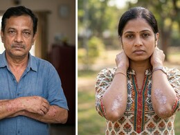 Eczema vs Psoriasis: Which Skin Condition Is Responsible For That Persistent Itch?