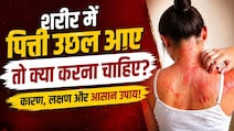 अचानक शरीर पर पित्ती उछल आए तो क्या करें? घबराएं नहीं, ये आसान उपाय तुरंत देंगे राहत!