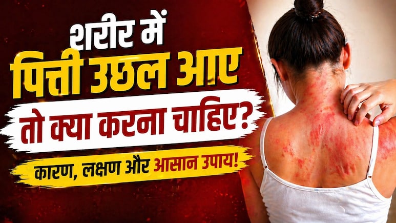 अचानक शरीर पर पित्ती उछल आए तो क्या करें? घबराएं नहीं, ये आसान उपाय तुरंत देंगे राहत!