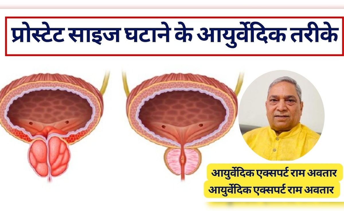 अनुभव‍ी आयुर्वेद एक्‍सपर्ट का दावा, ये आयुर्वेदिक उपाय कम कर सकते हैं बढ़ा प्रोस्टेट, जान लें घरेलू इलाज और प्रोस्टेट साइज घटाने के तरीके