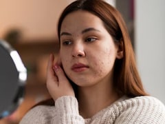 What Is Hormonal Acne? Delhi Dermatologist Explains Triggers
