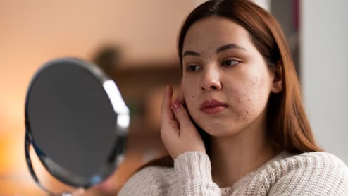 What Is Hormonal Acne? Delhi Dermatologist Explains Triggers