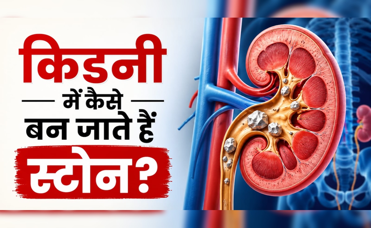 आखिर Kidney Stone होता क्यों है? सिर्फ खाना-पीना ही नहीं इन 3 वजहों से भी होती है किडनी में पथरी