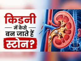 आखिर Kidney Stone होता क्यों है? सिर्फ खाना-पीना ही नहीं इन 3 वजहों से भी होती है किडनी में पथरी