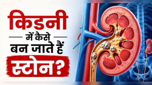 आखिर Kidney Stone होता क्यों है? सिर्फ खाना-पीना ही नहीं इन 3 वजहों से भी होती है किडनी में पथरी