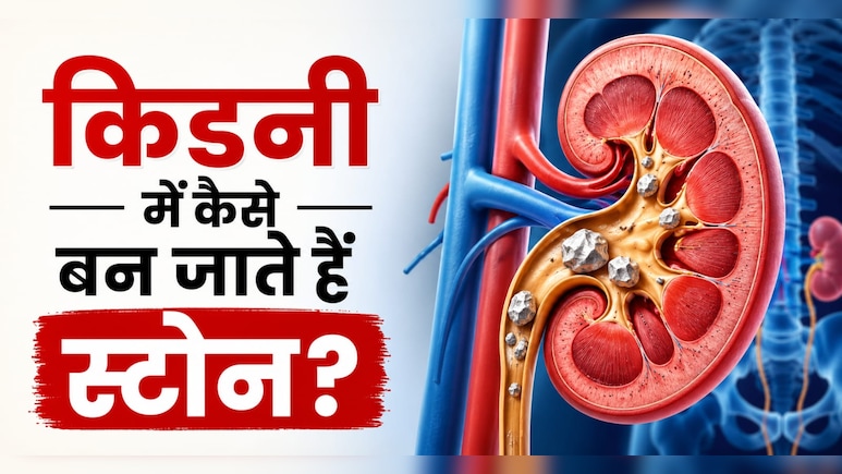 आखिर Kidney Stone होता क्यों है? सिर्फ खाना-पीना ही नहीं इन 3 वजहों से भी होती है किडनी में पथरी