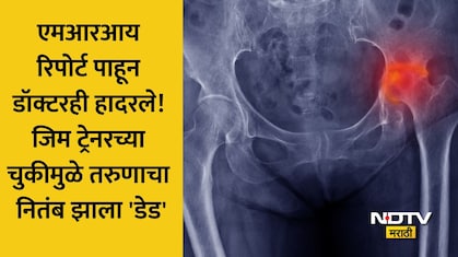 Shocking जिम ट्रेनरने 80,000 उकळले, इंजेक्शनमुळे रक्तपुरवठा थांबला अन् हाड सडलं; नितंबावर झाला हा गंभीर परिणाम