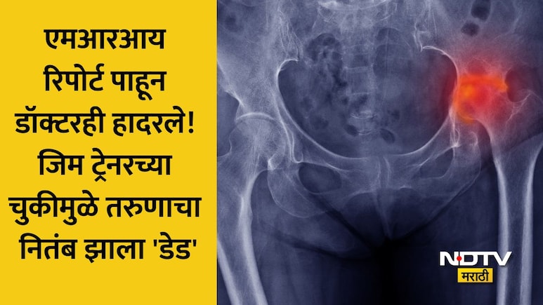 Shocking जिम ट्रेनरने 80,000 उकळले, इंजेक्शनमुळे रक्तपुरवठा थांबला अन् हाड सडलं; नितंबावर झाला हा गंभीर परिणाम
