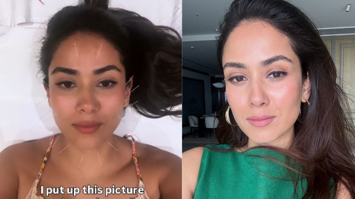 Mira Kapoor Swears By Cosmetic Acupuncture, Shares Benefits: 'Face Looks Incredibly Better'