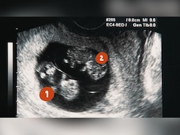 जुड़वा बहनों के पिता अलग-अलग कैसे हो गए? ब्रिटेन में अनोखा मामला, DNA टेस्ट ने खोला राज