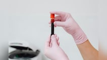VeloCD Blood Test: अब ब्लड टेस्ट से पहले ही चल सकेगा पता, बीमारी बढ़ेगी या मरीज जल्दी होगा ठीक!