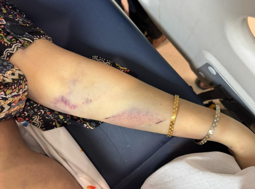 The injury marks as seen on Deepika Nagars body The injury marks as seen on Deepika Nagars body