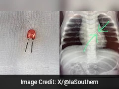 Army Doctors Pull Off Miracle By Removing LED Bulb From 9-Month Baby's Lung