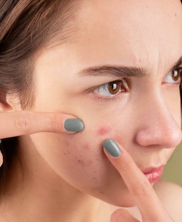 Tips For Prevent Acne During Summer