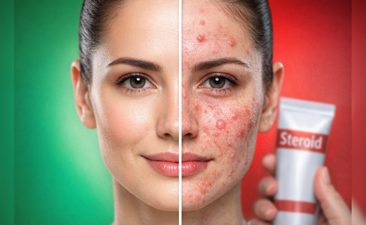सावधान! गोरा होने के चक्‍कर में चेहरे पर लगा रहे हैं Betnovate Cream? हो सकते हैं गंभीर नुकसान, डॉक्टर की चेतावनी