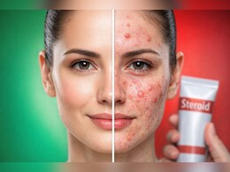 सावधान! गोरा होने के चक्&zwj;कर में चेहरे पर लगा रहे हैं Betnovate Cream? हो सकते हैं गंभीर नुकसान, डॉक्टर की चेतावनी