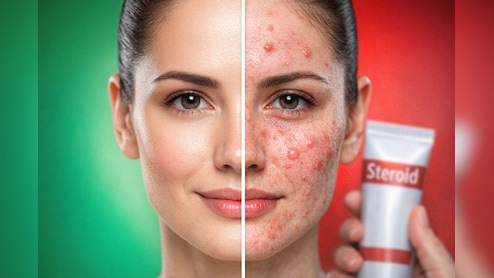 सावधान! गोरा होने के चक्&zwj;कर में चेहरे पर लगा रहे हैं Betnovate Cream? हो सकते हैं गंभीर नुकसान, डॉक्टर की चेतावनी