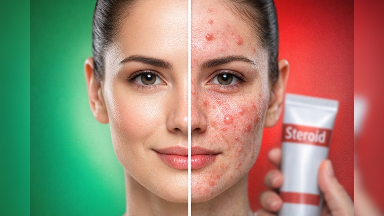 सावधान! गोरा होने के चक्&zwj;कर में चेहरे पर लगा रहे हैं Betnovate Cream? हो सकते हैं गंभीर नुकसान, डॉक्टर की चेतावनी