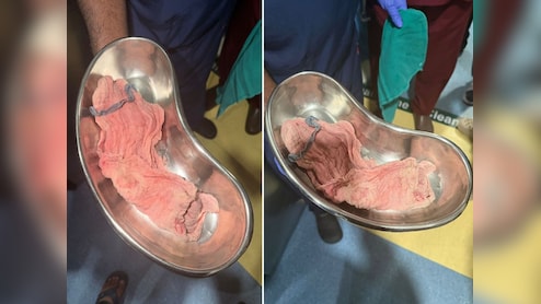 मुंबई के नूर अस्पताल में डिलीवरी के बाद महिला के पेट में छोड़े हैंड ग्लव्स और बैंडेज, हालत बिगड़ी