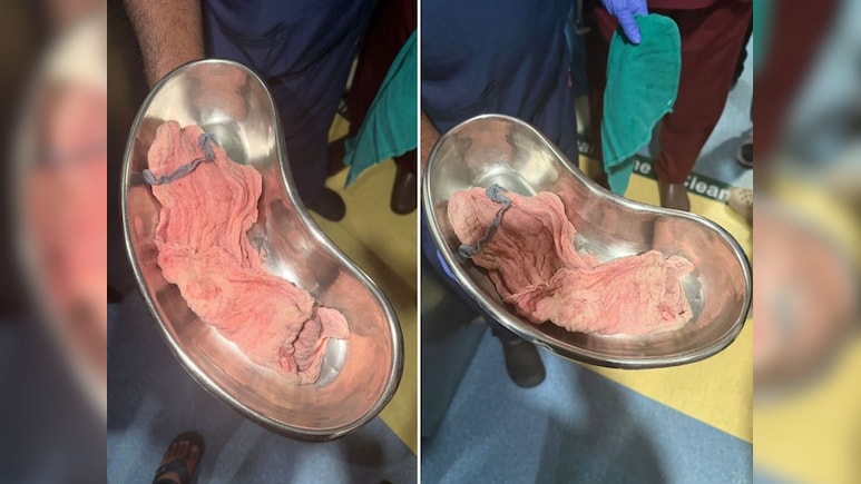 मुंबई के नूर अस्पताल में डिलीवरी के बाद महिला के पेट में छोड़े हैंड ग्लव्स और बैंडेज, हालत बिगड़ी