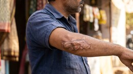 Can Your Old Burns Transform Into Cancer? Here's What You Should Know