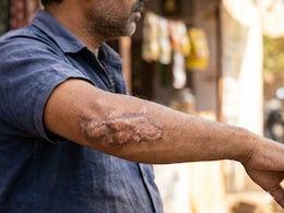 Can Your Old Burns Transform Into Cancer? Here's What You Should Know