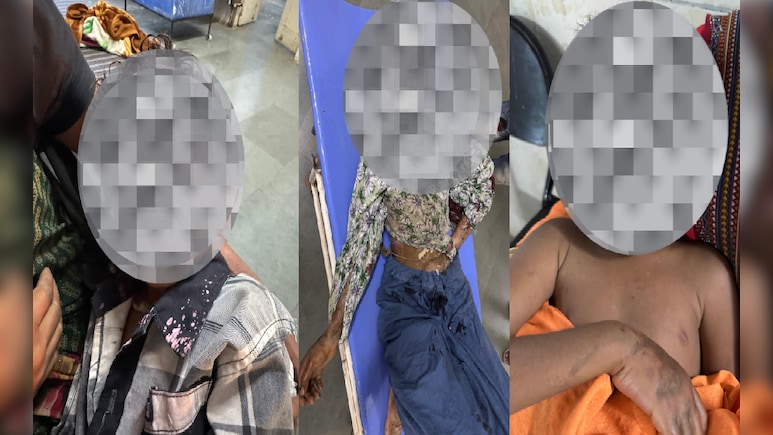 एसिड बना जानलेवा: ड्रिप लाइन सफाई के लिए रखा केन गिरा, मां की मौत, दो मासूम झुलसे