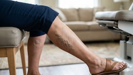 Struggling With Varicose Veins? Lifestyle Coach Shares Signs, Causes And Simple Remedies