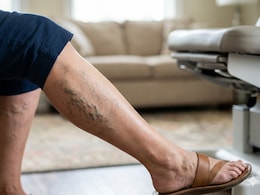 Struggling With Varicose Veins? Lifestyle Coach Shares Signs, Causes And Simple Remedies