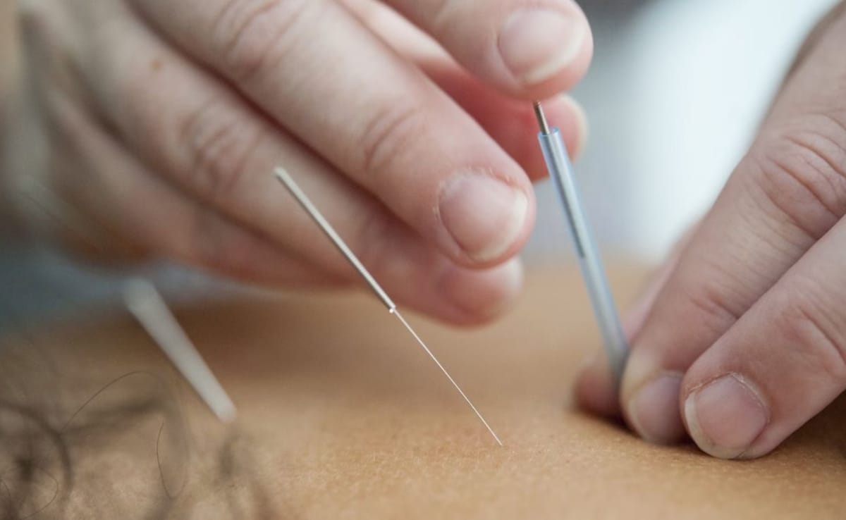 Facial acupuncture is not the first line of treatment for pigmentation disorders, active acne, major skin sagging, or acne scars. Photo: Unsplash Facial acupuncture is not the first line of treatment for pigmentation disorders, active acne, major skin sagging, or acne scars. Photo: Unsplash