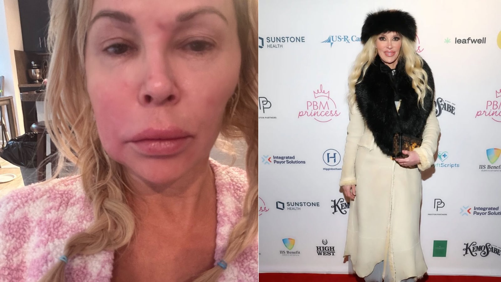 Brandi Glanville Reveals Benign Face Tumour Amid Ongoing Health Battle