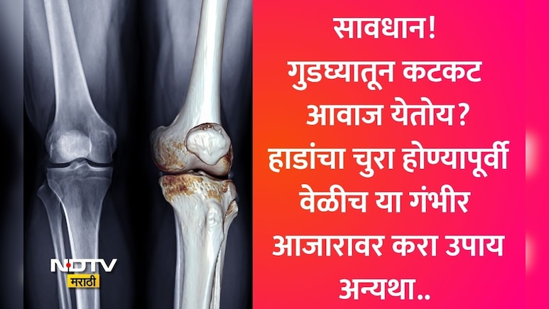Osteoarthritis Treatment: गुडघ्यातून कटकट आवाज येतो? जिने चढताना त्रास होतो? डॉक्टरांनी केला धक्कादायक खुलासा