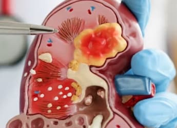 Kidney Cancer Myths Debunked: What Doctors Want You To Know