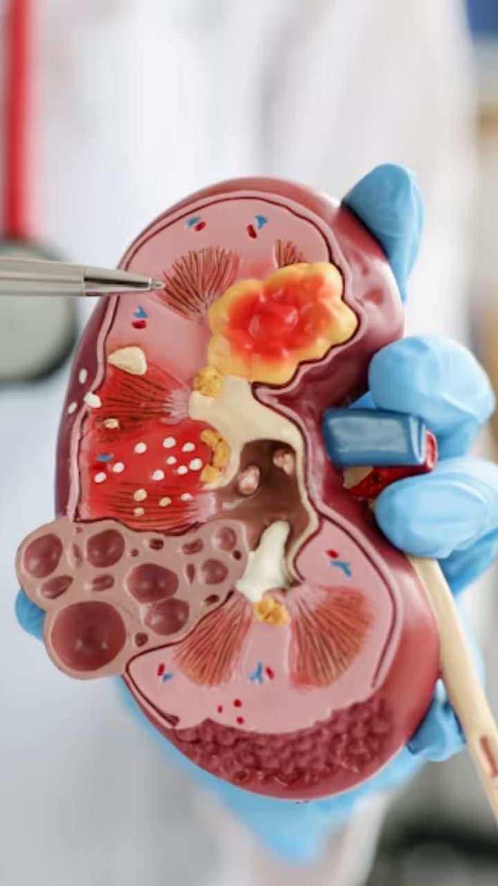 Kidney Cancer Myths Debunked: What Doctors Want You To Know